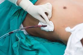 Chest drain