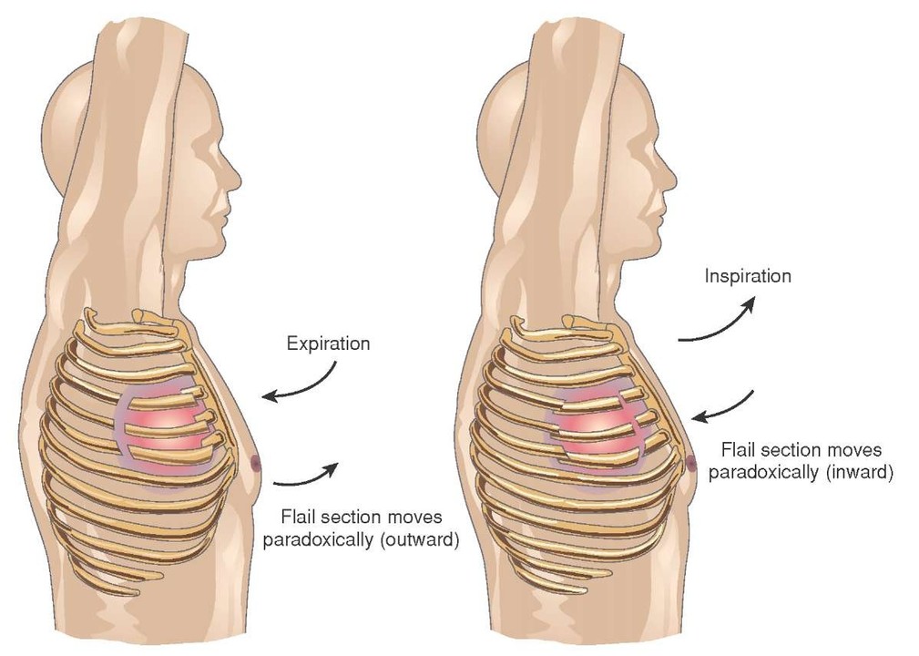 Flail chest