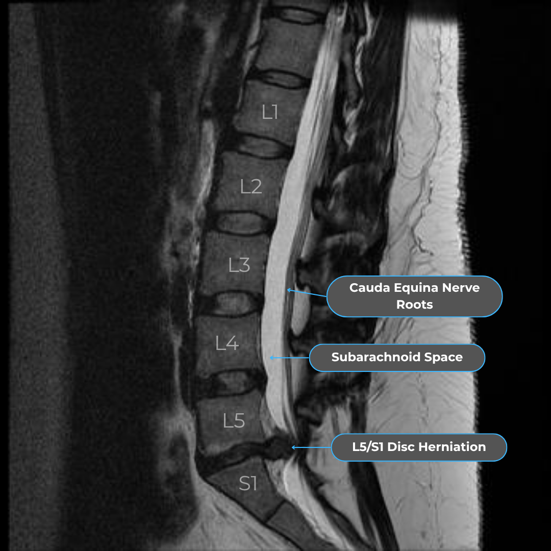Sagittal T2 MRI