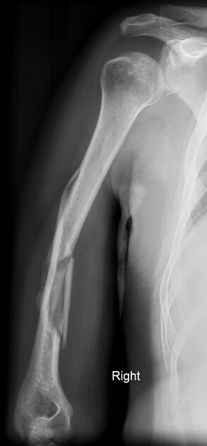 Comminuted fracture