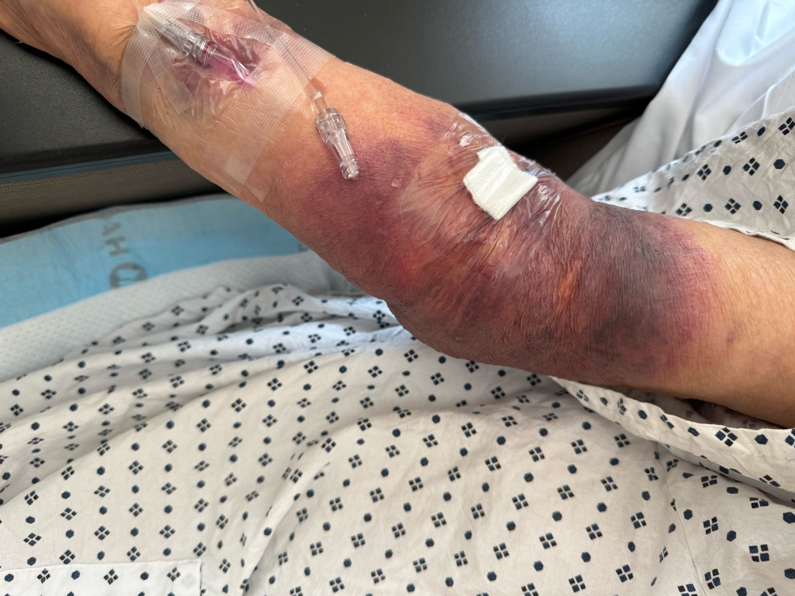 IV extravasation causing compartment syndrome