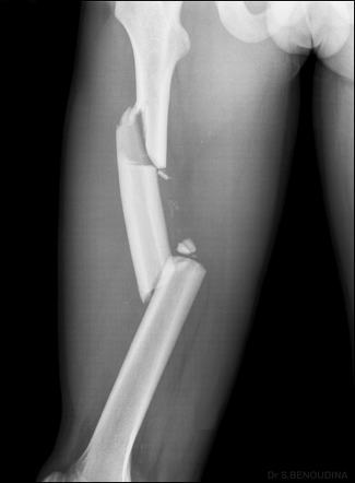 Segmental fracture