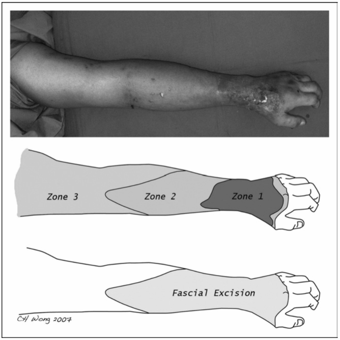 Surgical debridement of necrotising fasciitis