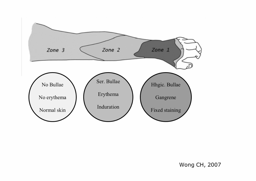 Surgical debridement of necrotising fasciitis