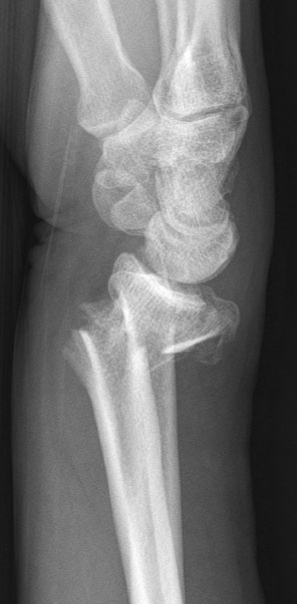 Distal radius fracture X-ray