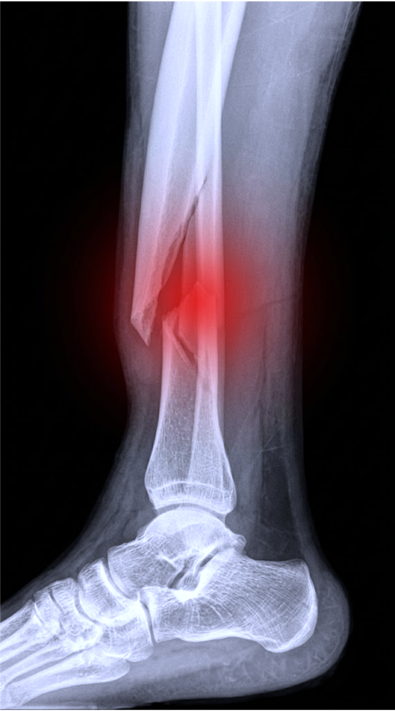 Open Fractures