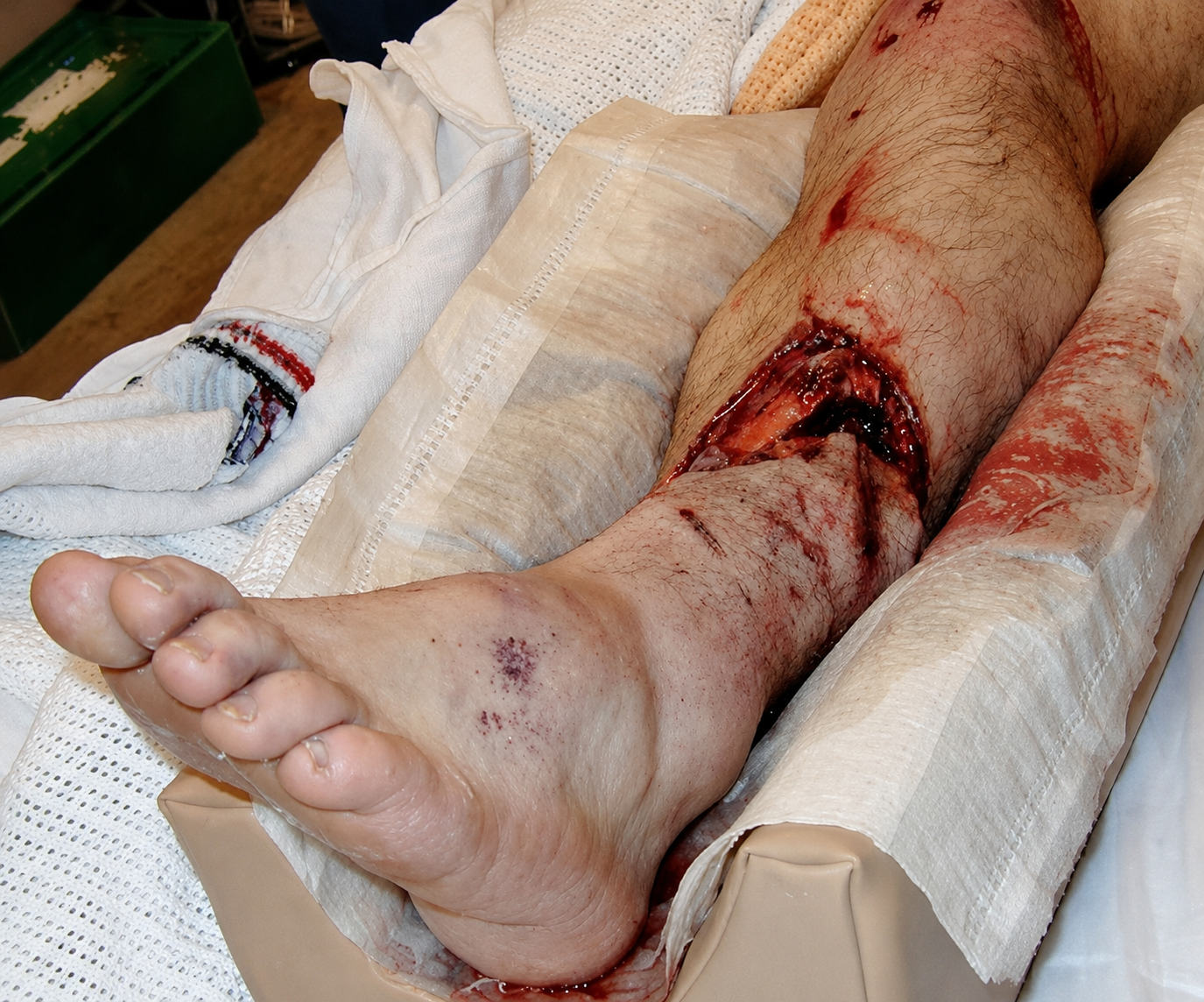Open fracture clinical illustration