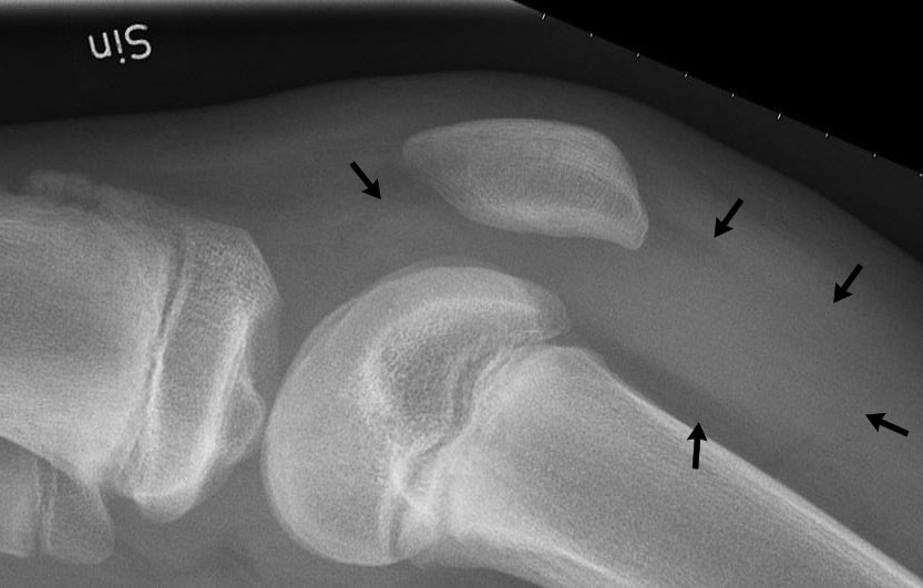 X-ray of knee showing effusion